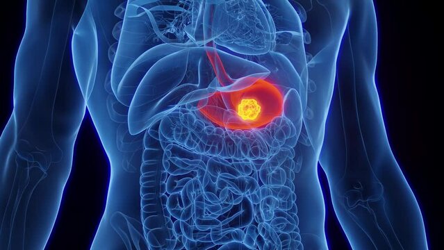 Animation of cancerous mass in a man's stomach