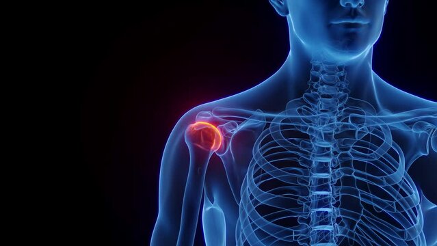 Animation of a man's painful, inflamed right shoulder
