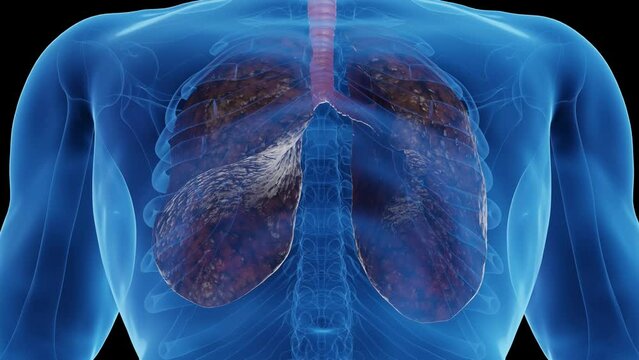 Animation of a smoker's lungs