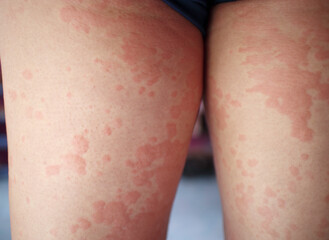 Dermatitis, Asian man, man pinches leg allergy, allergic reaction, insect bites, hand scratching,...