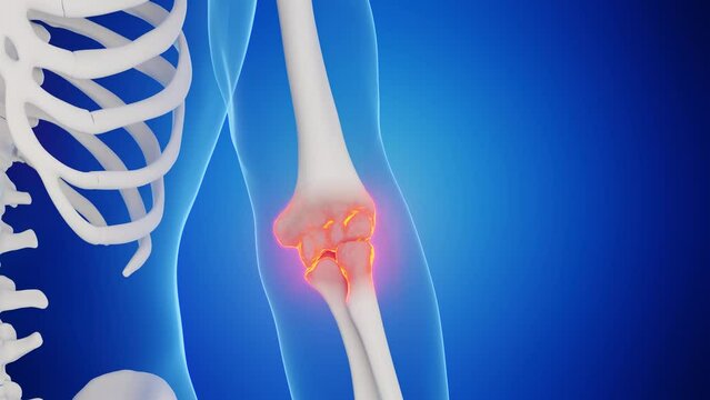 Animation of a man's left elbow joint