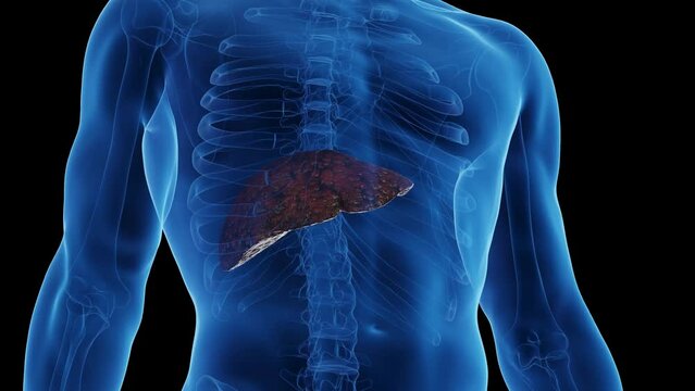 Animation of a man's cirrhotic liver