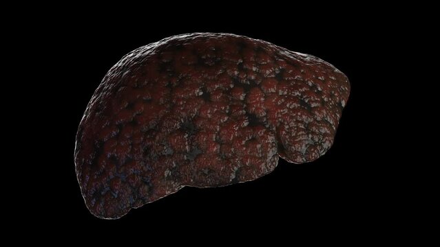 Animation of a man's cirrhotic liver