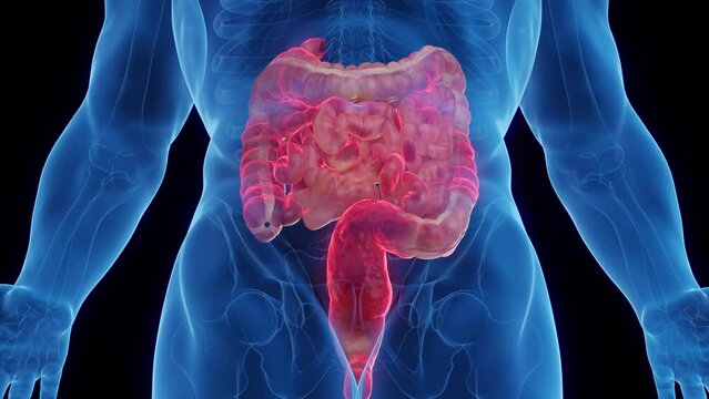 Animation of a man's intestines affected by Crohn's disease
