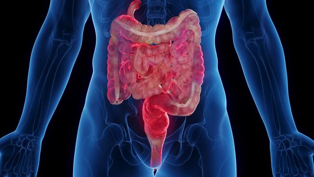 Animation of a man's intestines affected by Crohn's disease