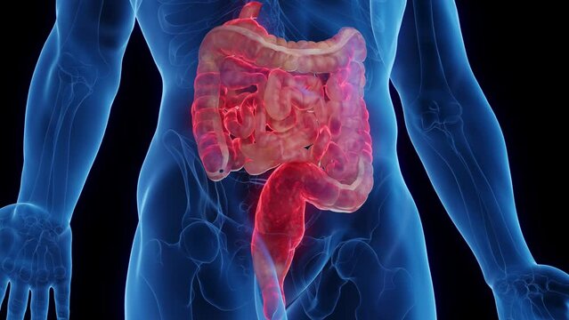 Animation of a man's intestines affected by Crohn's disease