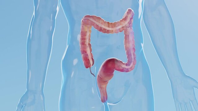 Animation of a man's inflamed colon