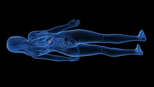 Animation of a cancerous tumor in a woman's adrenal glands