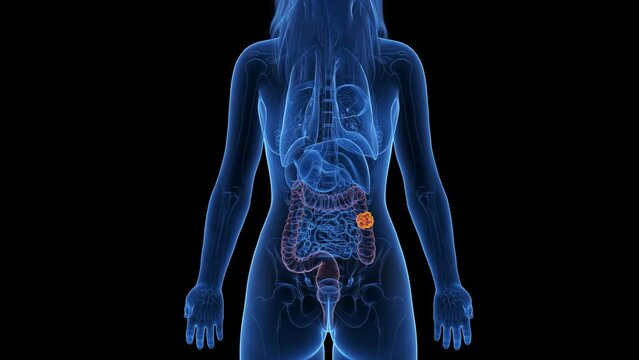 Animation of a cancerous tumor in a woman's colon
