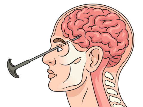 Lobotomy leucotomy neurosurgical treatment in brain diagram schematic vector illustration. Medical science educational illustration
