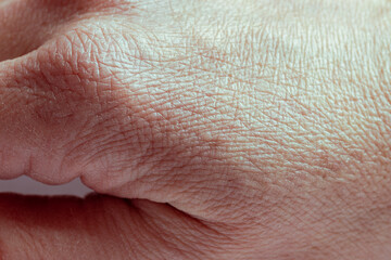 Close up of the wrinkled skin on the hand of an older man with some lesions of actinic keratosis or...