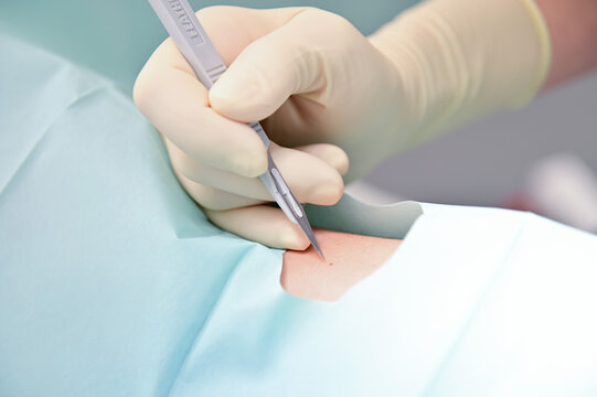 Female dermatologist removes birthmark for skin cancer prevention using a scalpel for the surgery on patient in clinic