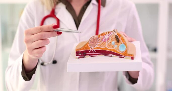 Female doctor explains disease and using anatomical model of breast. Breast cancer symptoms signs and diagnosis