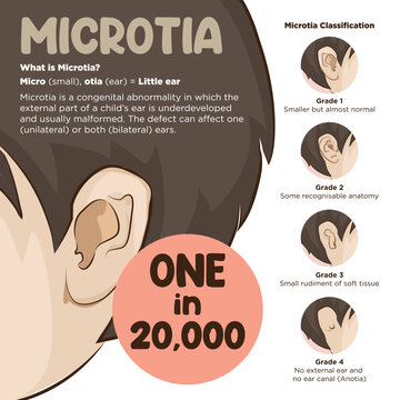Art vector and infographic of Microtia. Ear birth defect. Awareness poster