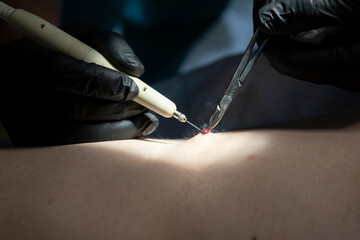 Doctor performing surgery for mole removal - obrazy, fototapety, plakaty