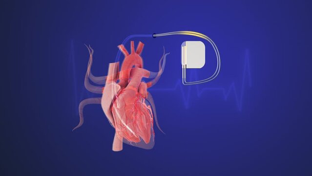 Artificial heartbeats in a cardiac pacemaker with heartbeat wave lines