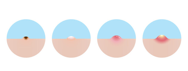 Types of acne vector icon set illustration isolated on white background. Formation of acne, blackhead, whitehead, papule and pustule. Flat design vector acne illustration. Skin care concept.