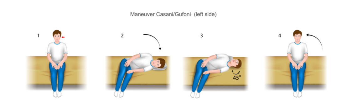 Casani Gufoni maneuver left side