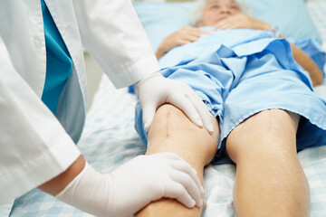 Doctor checking Asian elderly woman patient with scar knee replacement surgery in hospital.