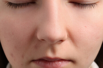 Young woman with acne problem, closeup view