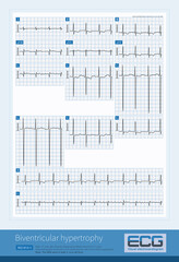 When the QRS wave in the V2-V4 chest lead is biphasic and has an amplitude exceeding 60mm, it is necessary to be vigilant about the electrocardiogram of biventricular hypertrophy.