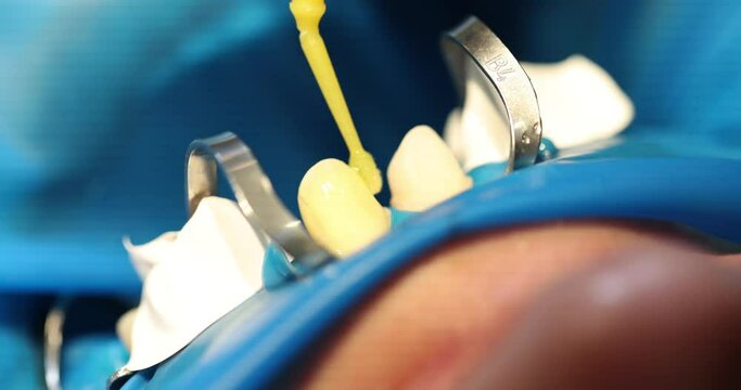 Usage of special photopolymer filling and yellow stick in luxury dentistry. Process of teeth whitening against yellowness in dentist clinic