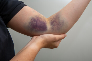 Large bruise in the middle of an arm. - obrazy, fototapety, plakaty