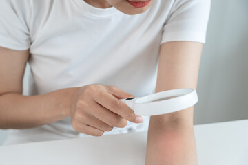 skin problem and beauty. asian woman use magnifying glass look itchy skin from skin allergic, shocked, steroid allergy, sensitive skin, chemical allergy, rash, insect bites, Seborrheic Dermatitis.