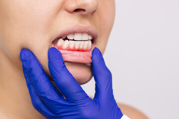 Gum inflammation. Young woman's face with doctor's hand in a blue glove on the jaw showing red...