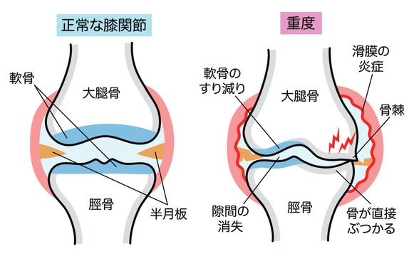 正常な膝関節と変形性膝関節症のシンプルな比較説明イラスト