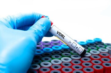 Blood sample of syphilis patient positive test for VDRL.