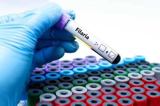 Blood sample of patient positive test for filaria. 