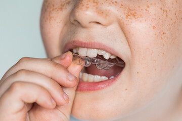 A boy is putting on clear teeth alignment bracket