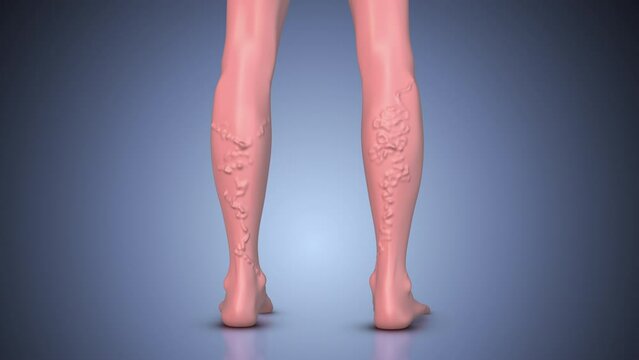 Concept of varicose veins, venous insufficiency, and vascular disease on leg