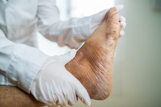Close-up shot of a broken heel of a person who is very heavy. there is an opening of cracks.Very severe, becoming infected and parched. Selective focus.