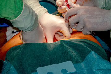 Preparing the patient for endoscopic surgery. Medical team of surgeons in the hospital who perform...