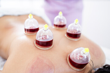 Hijama cups filled with blood on woman's body.