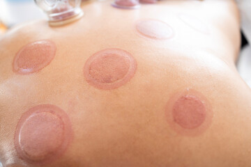 Fototapeta premium Wet cupping marks and cuts on patient after hijama treatment.
