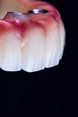 dental photography of full arch zircon bridge on implants