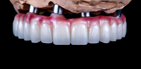 dental photography of full arch zircon bridge on implants
