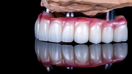 dental photography of full arch zircon bridge on implants