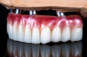 dental photography of full arch zircon bridge on implants