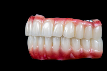 dental photography of full arch zircon bridge on implants