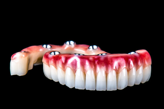 Dental Photography Of Full Arch Zircon Bridge On Implants