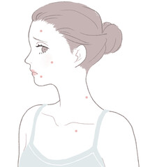 ニキビに悩む女性