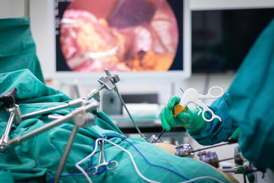 Minimally invasive surgery laparoscopic sleeve gastrectomy
