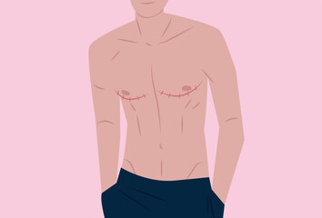 Shirtless Trans Man Proudly Showing Top Surgery Scars, FTM, Transgender, Post-Op Medical Surgery - obrazy, fototapety, plakaty