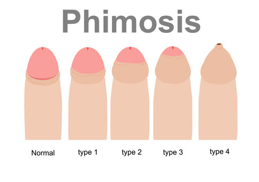 Phimosis is a condition of the penis that occurs in some adults and children who aren't circumcised.