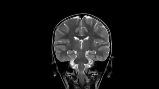 Human Skull MRI Scanning