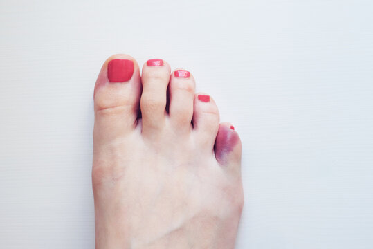 Foot with broken pinky toe caused by forceful impact with furniture. Baby toe fracture and hematoma.